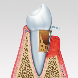 Behandlung von Paradontose und Paradontitis